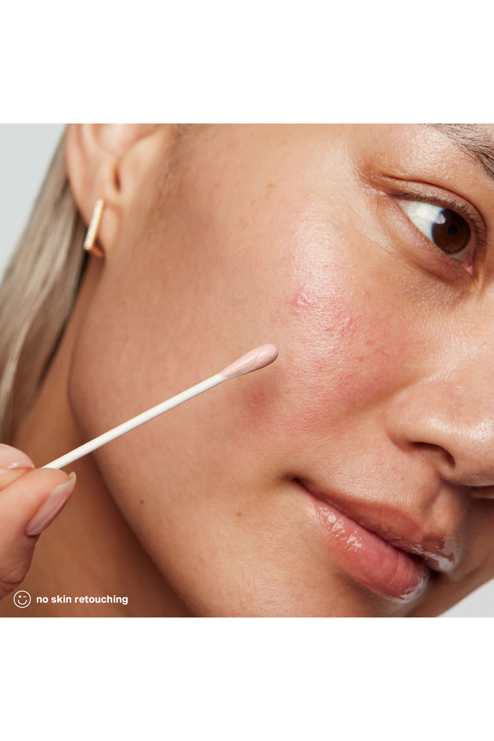 مستحضر علاجي اراديكايت للحبوب 10% كبريت